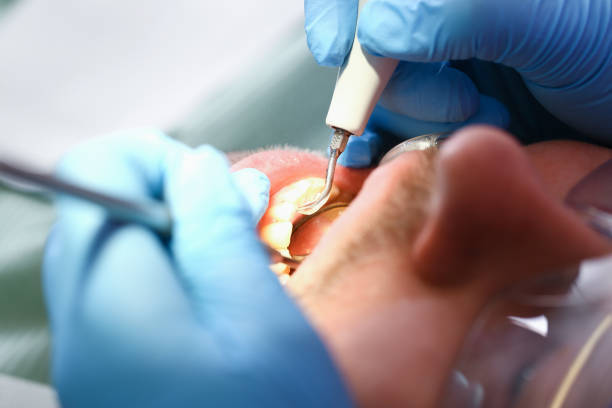 Best Emergency Dental Extractions in Chillicothe, OH